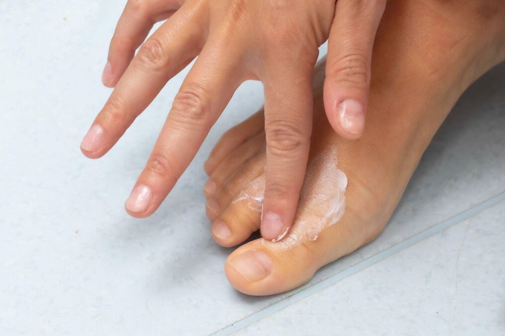 Demyxil -Creme -Anwendung des Pilzes zwischen den Fingern der Feets