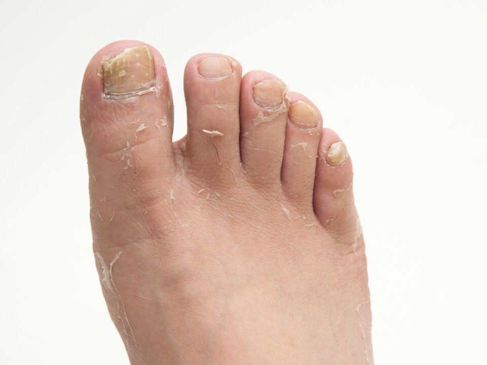 Pilz auf der Haut der Beine und seiner Behandlung mit Demyxil -Creme