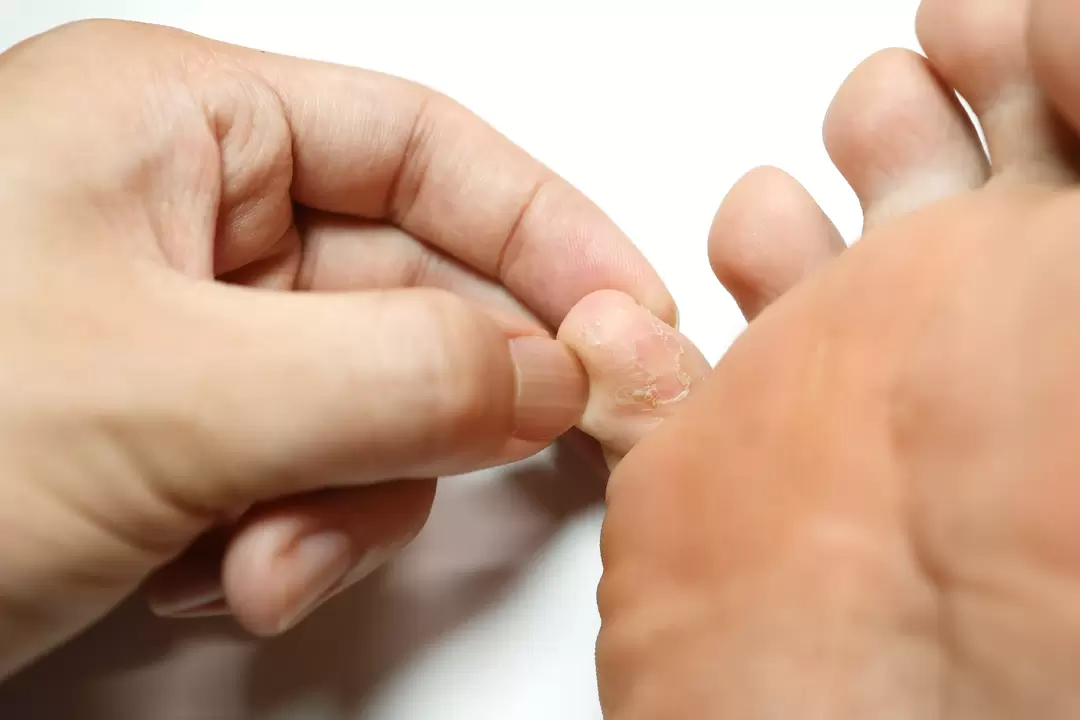 Pilz über die Finger und ihre Behandlung mit Demyxil -Creme