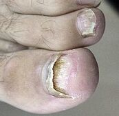 Nagelpilzstart