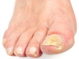 Nagelpilz