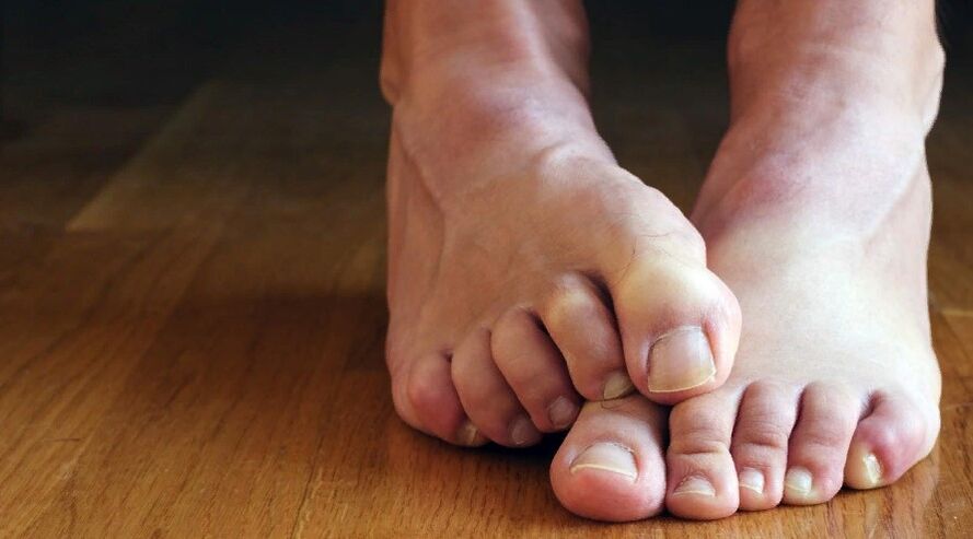 Nagelpilzsymptome