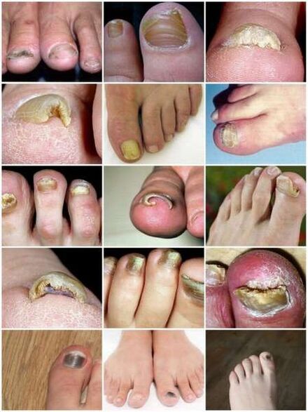 Pilzinfektion der Zehennagelplatte.