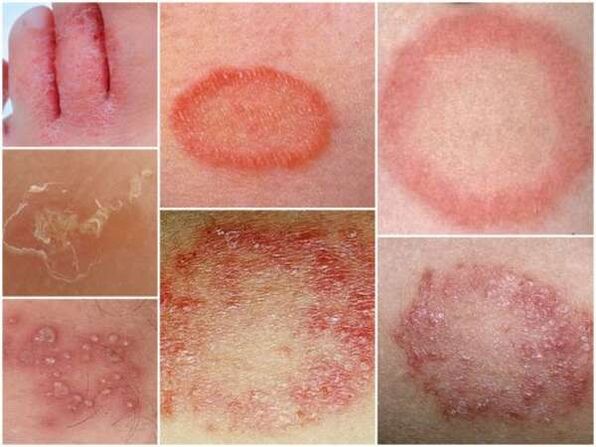 Trichophytose der Haut der Beine.